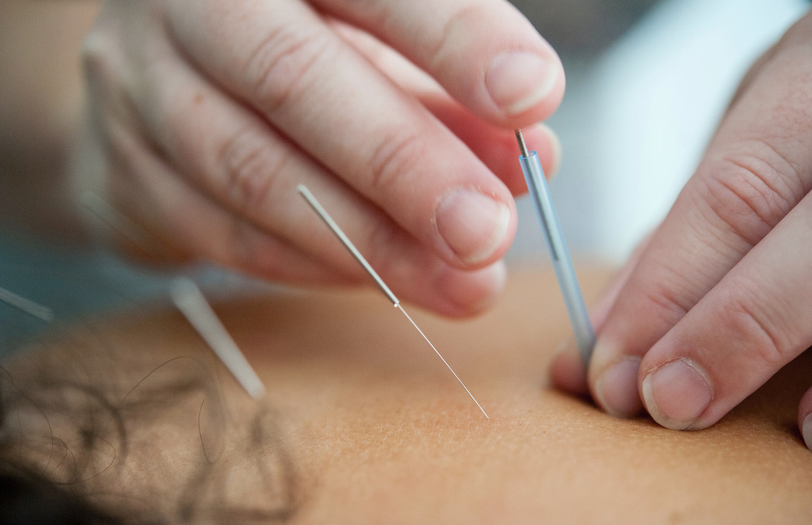 Alternative therapies for Dry Eyes: spotlight on Acupuncture for Dry Eyes