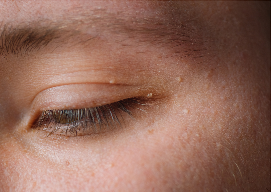 What is a milia and how can I get rid of them? 