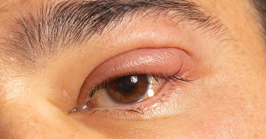 hypochlorous-acid-for-styes-what-it-does-and-what-it-cannot