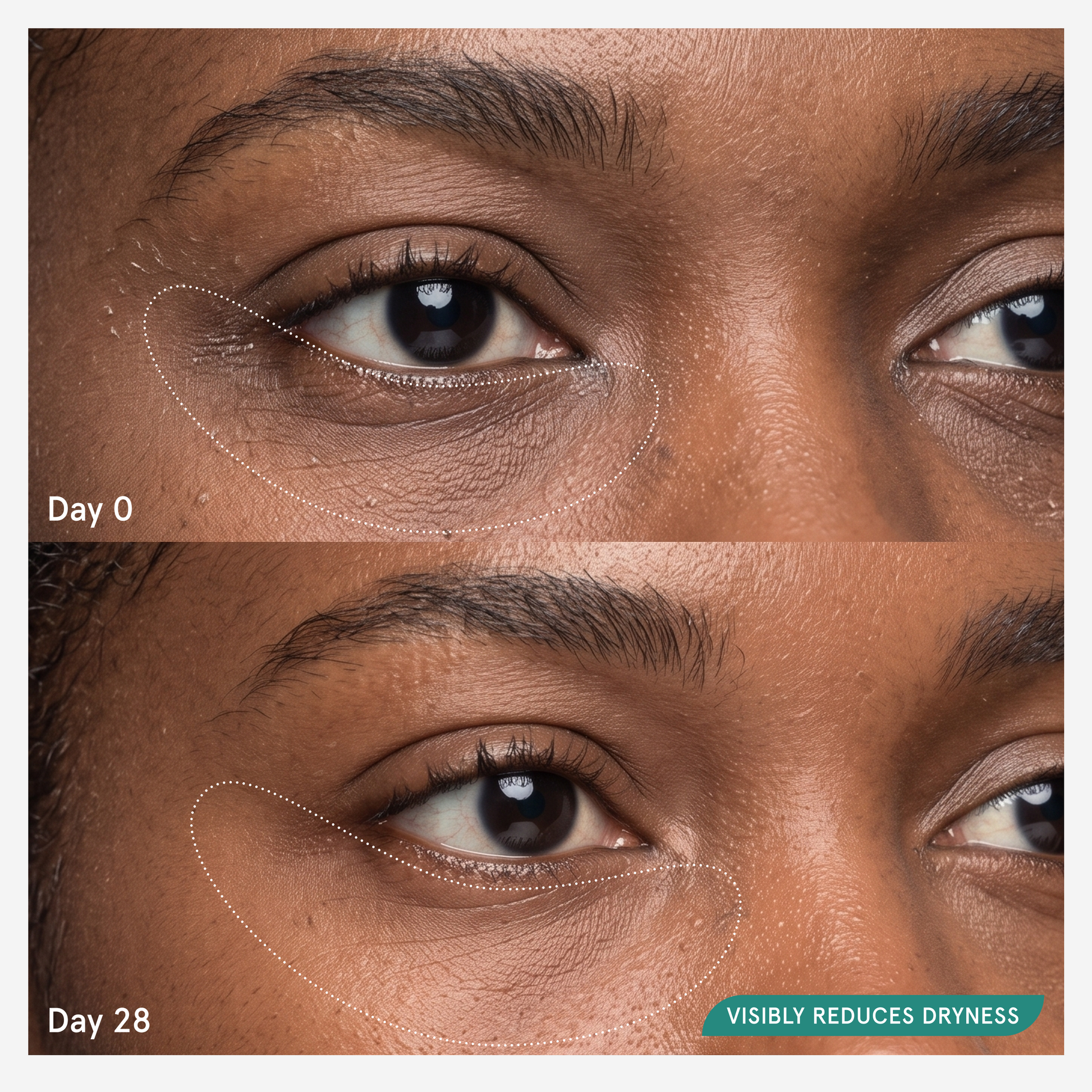 Before and after comparison at day 0 and day 28 showing visibly reduced dryness around the eyes