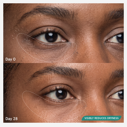 Before and after comparison at day 0 and day 28 showing visibly reduced dryness around the eyes